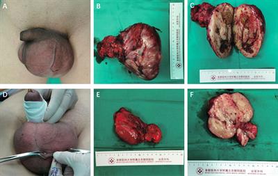 Case report: Two cases of primary paratesticular liposarcoma